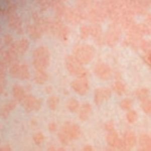 Wajib Tahu! Cara Menghilangkan Panu Hanya dengan Menggunakan Bahan Alami